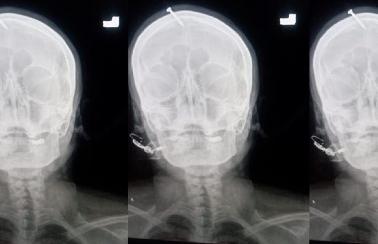 Una curandera convenció a una mujer embarazada de que al clavarle un clavo en el cráneo nacería un niño, según los médicos