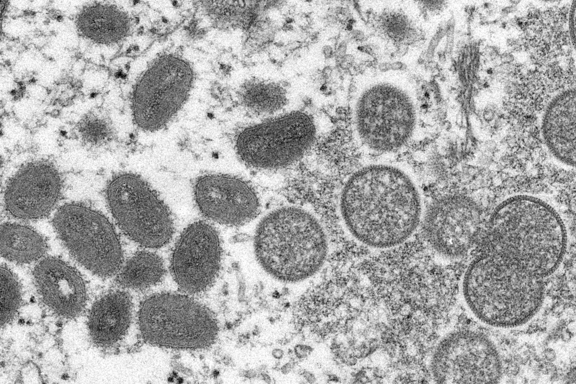EE.UU. aumenta las pruebas de viruela del mono, se confirman 142 casos