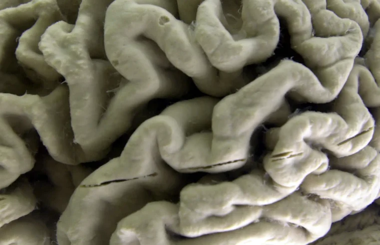 El fármaco frena el Alzheimer, pero ¿puede marcar una diferencia real?