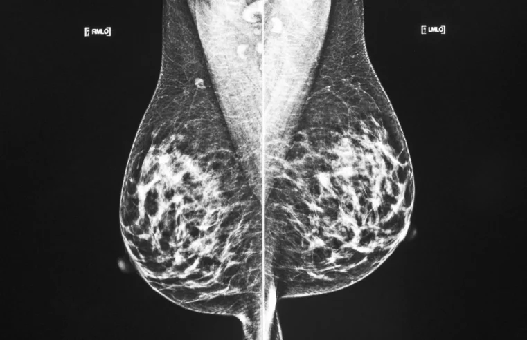 Más pacientes con cáncer de mama pueden optar por una cirugía menor